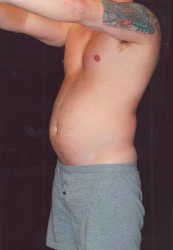 Male Body Contouring Before & After