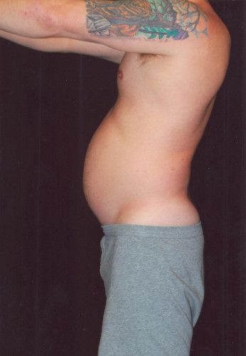 Male Body Contouring Before & After