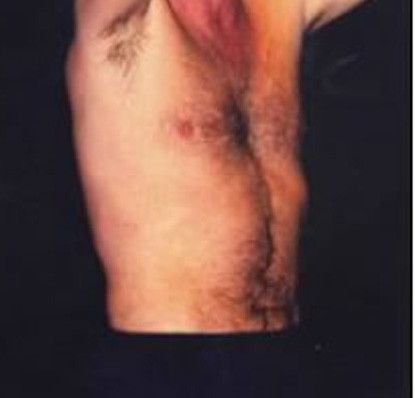 Male Body Contouring Before & After