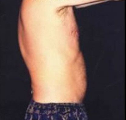 Male Body Contouring Before & After