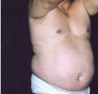 Male Body Contouring Before & After