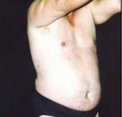 Male Body Contouring Before & After