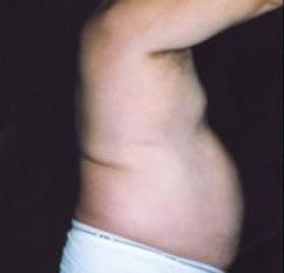 Male Body Contouring Before & After