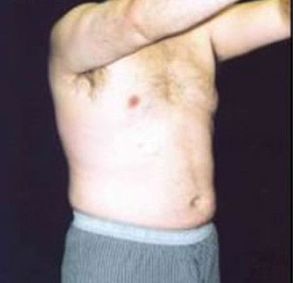 Male Body Contouring Before & After