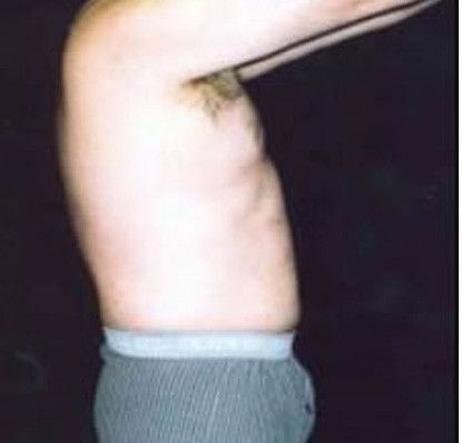 Male Body Contouring Before & After