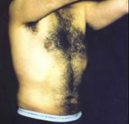 Male Body Contouring Before & After