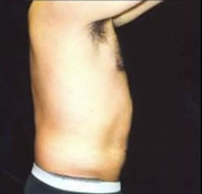 Male Body Contouring Before & After