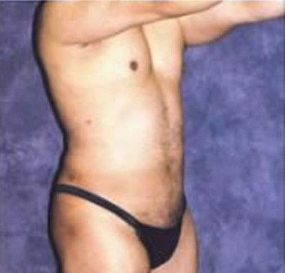 Male Body Contouring Before & After