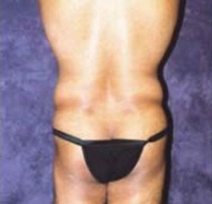 Male Body Contouring Before & After