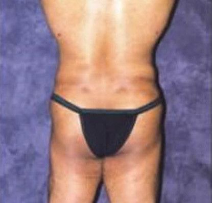 Male Body Contouring Before & After