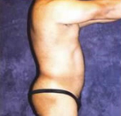 Male Body Contouring Before & After