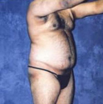 Male Body Contouring Before & After