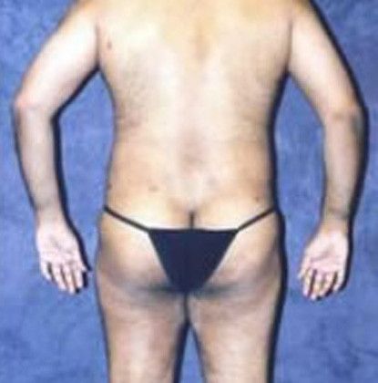 Male Body Contouring Before & After