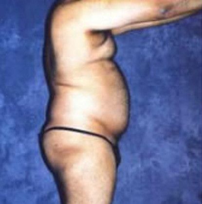 Male Body Contouring Before & After