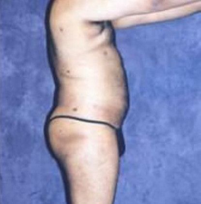 Male Body Contouring Before & After