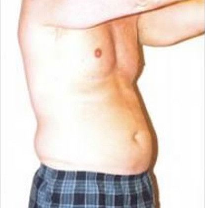 Male Body Contouring Before & After