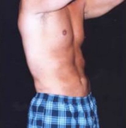 Male Body Contouring Before & After