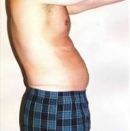 Male Body Contouring Before & After