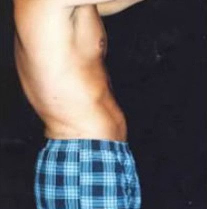 Male Body Contouring Before & After