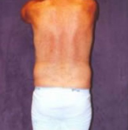 Male Body Contouring Before & After