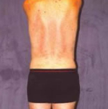 Male Body Contouring Before & After