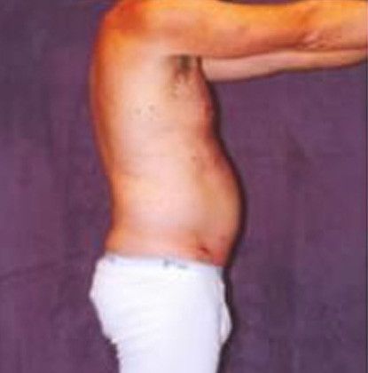 Male Body Contouring Before & After