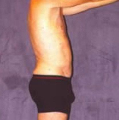 Male Body Contouring Before & After