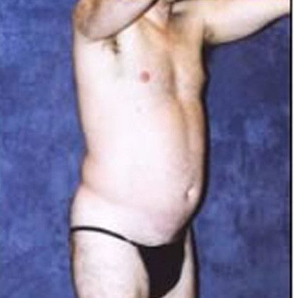 Male Body Contouring Before & After