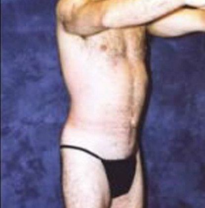 Male Body Contouring Before & After