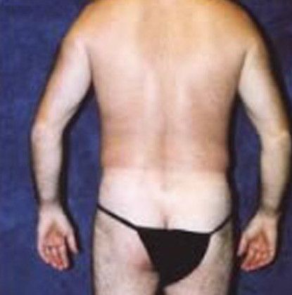 Male Body Contouring Before & After