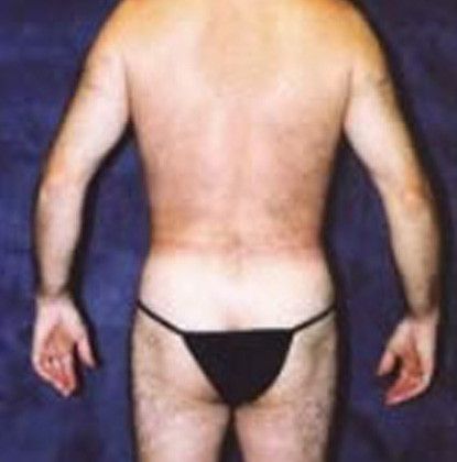 Male Body Contouring Before & After