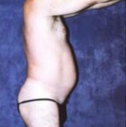 Male Body Contouring Before & After