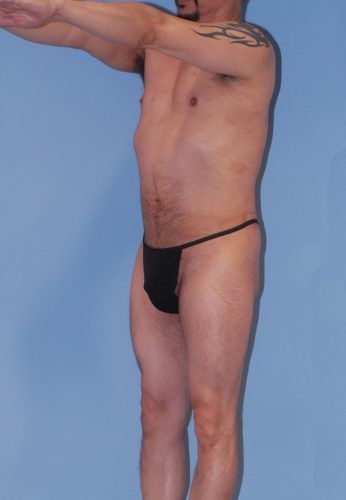 Male Body Contouring Before & After