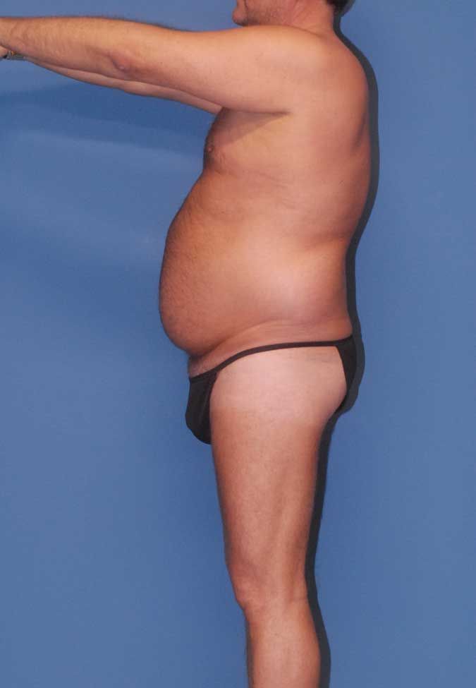 Male Body Contouring Before & After