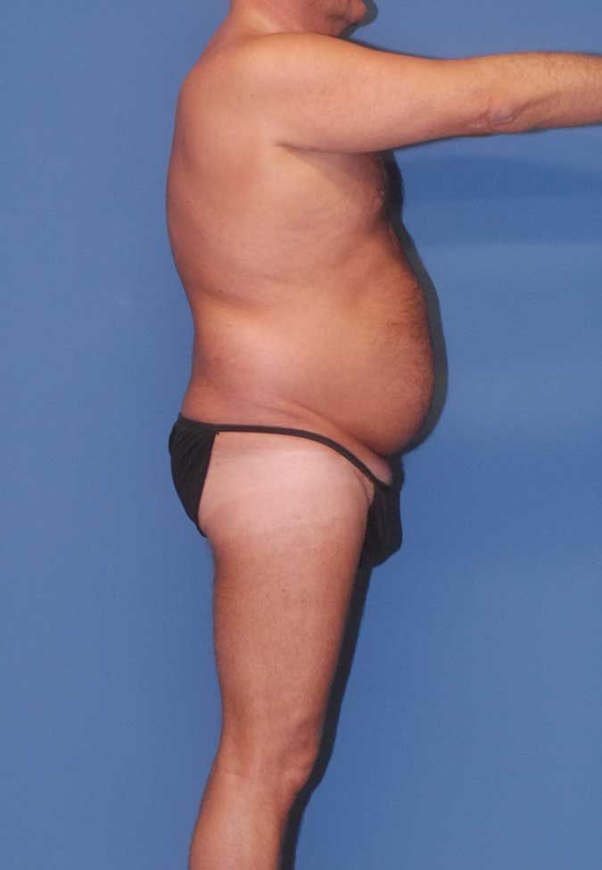 Male Body Contouring Before & After