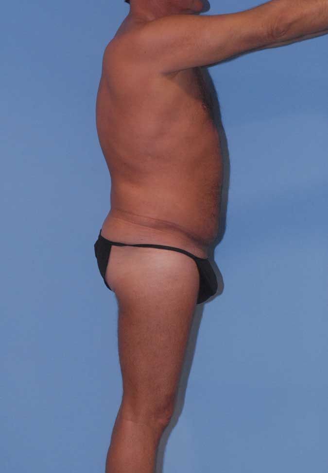 Male Body Contouring Before & After