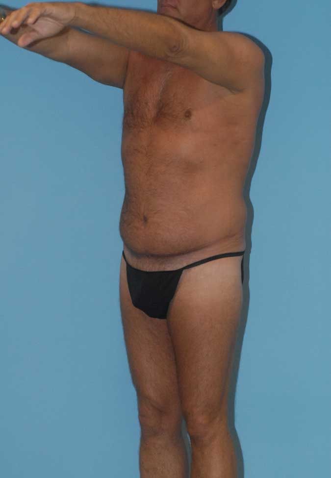 Male Body Contouring Before & After