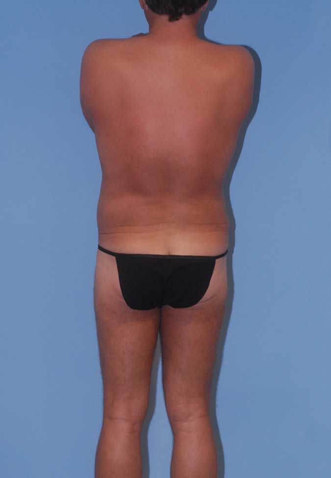 Male Body Contouring Before & After