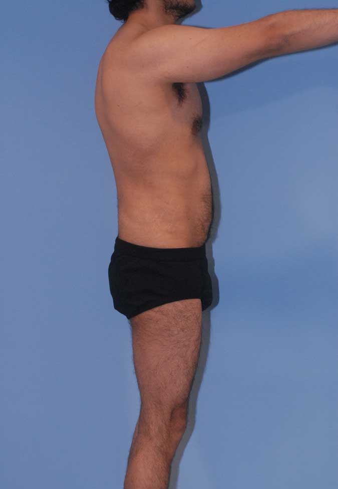 Male Body Contouring Before & After