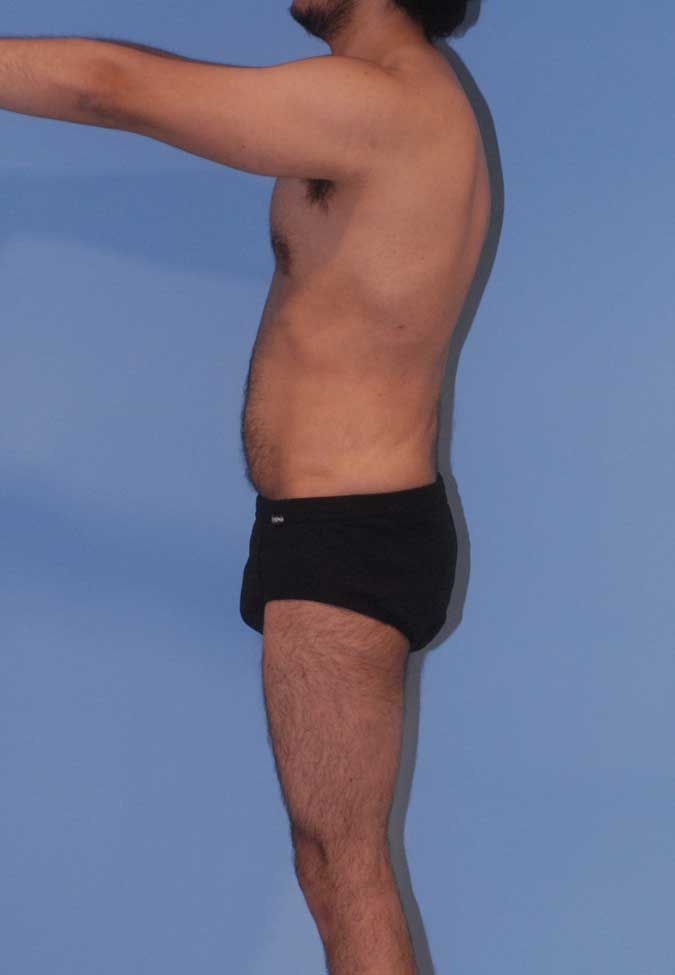 Male Body Contouring Before & After