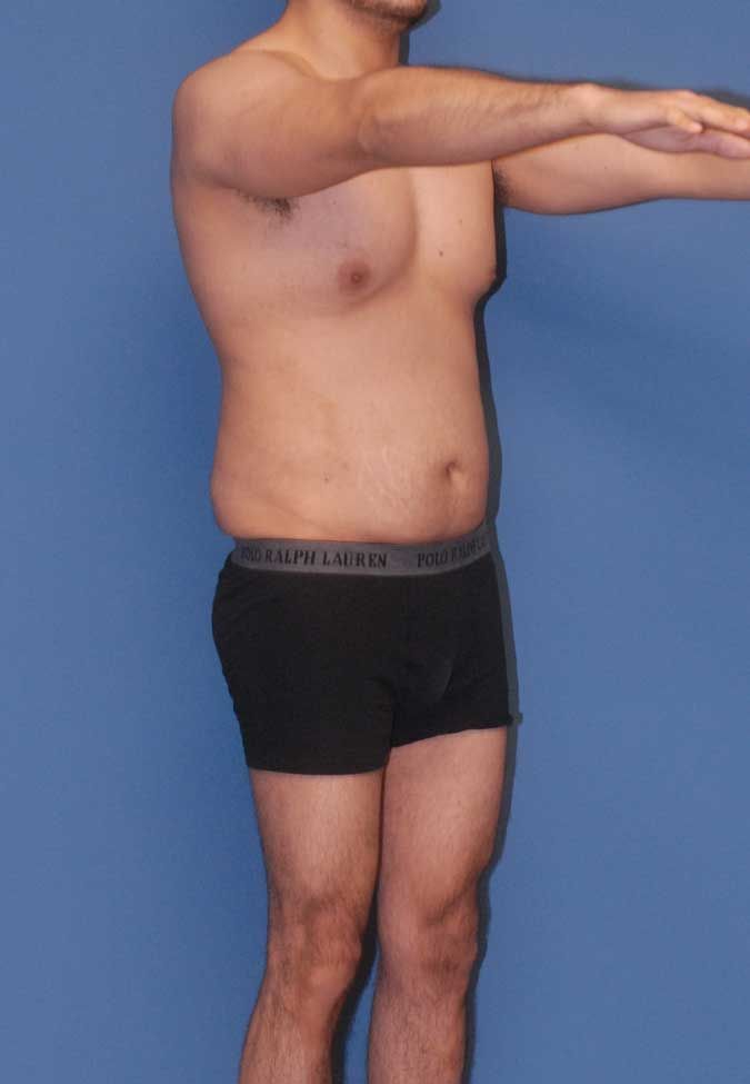 Male Body Contouring Before & After