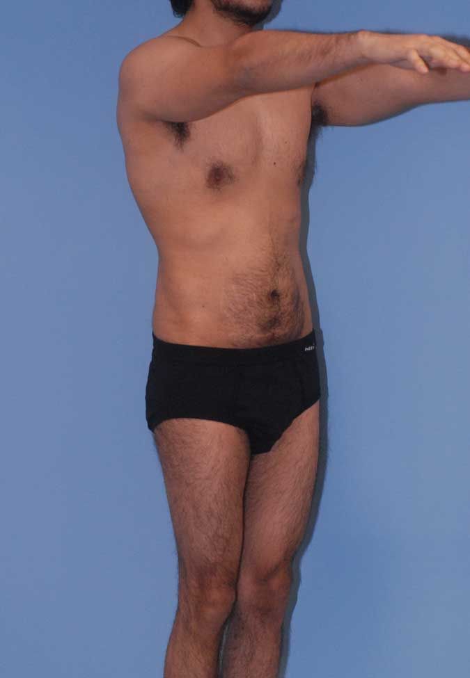 Male Body Contouring Before & After