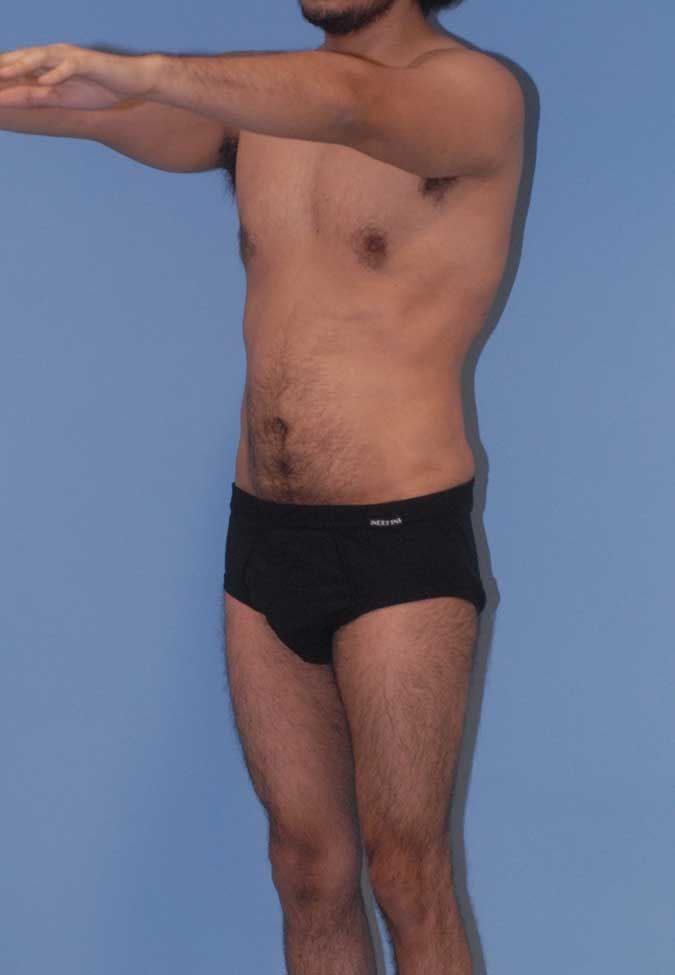 Male Body Contouring Before & After