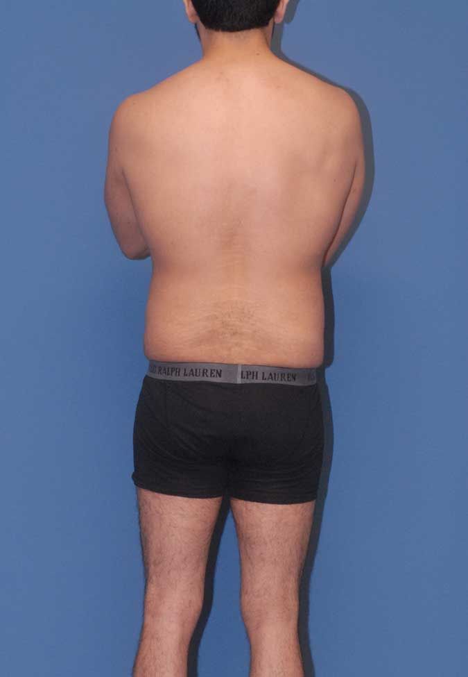 Male Body Contouring Before & After