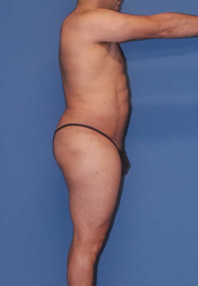 Male Body Contouring Before & After