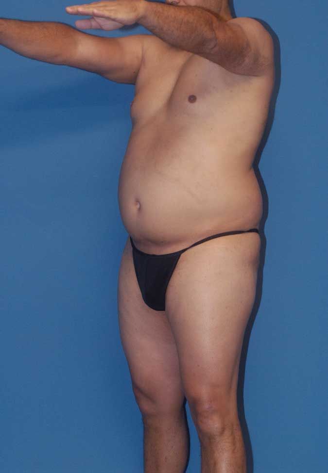 Male Body Contouring Before & After