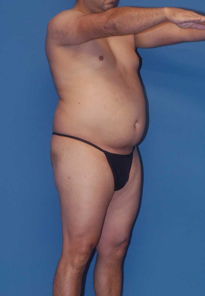 Male Body Contouring Before & After