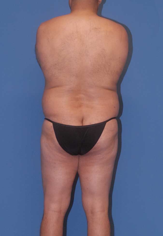 Male Body Contouring Before & After