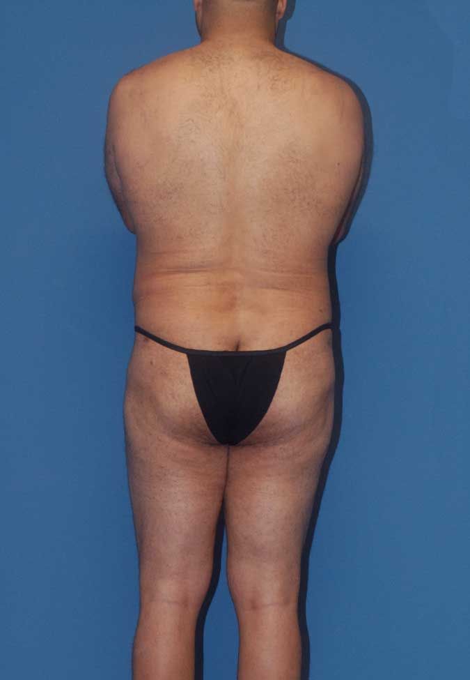 Male Body Contouring Before & After