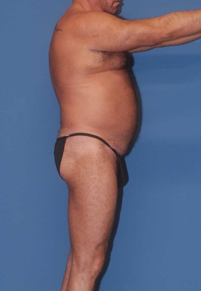 Male Body Contouring Before & After